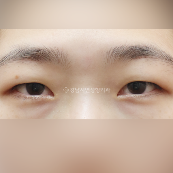 절개눈매교정+뒷트임+밑트임 BEFORE