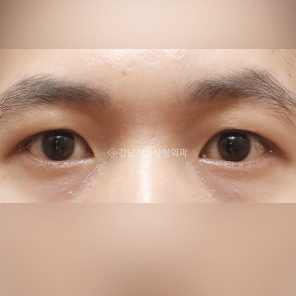 절개눈매교정 AFTER