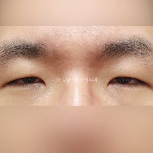절개눈매교정+앞트임 BEFORE