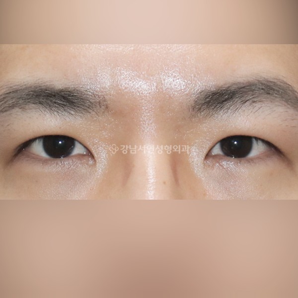 절개눈매교정+앞트임 AFTER