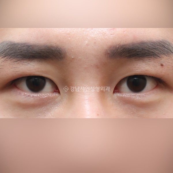 비절개눈매교정 AFTER
