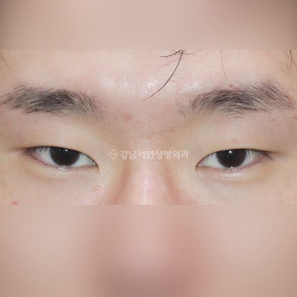 절개눈매교정+앞트임+뒷트임+밑트임 BEFORE