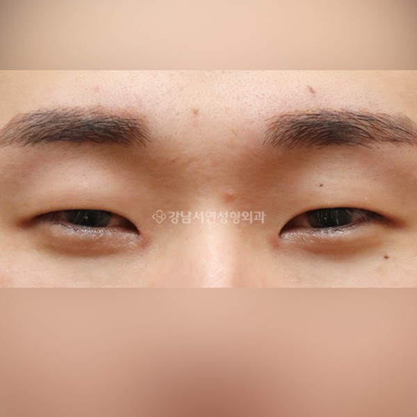 절개눈매교정+앞트임+뒷트임+밑트임 BEFORE