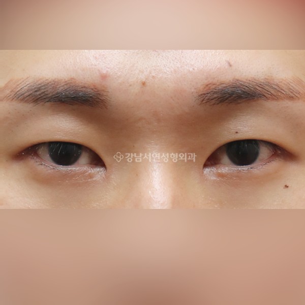 절개눈매교정+앞트임+뒷트임+밑트임 AFTER