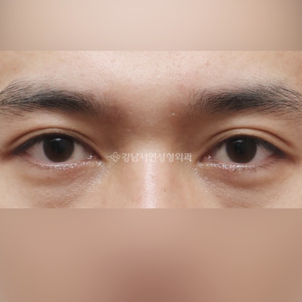 절개눈매교정 BEFORE