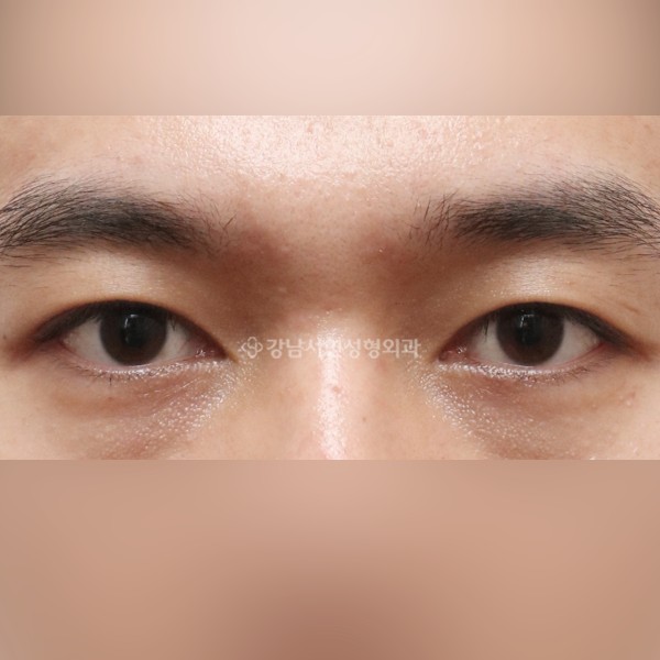 절개눈매교정 AFTER
