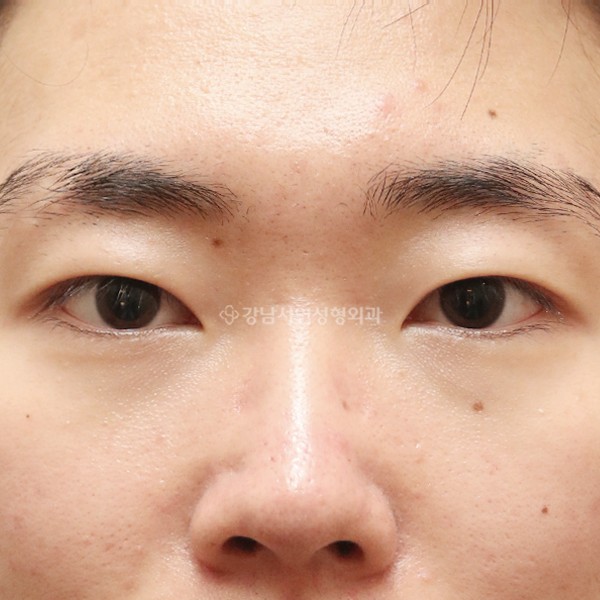 절개눈매교정 AFTER