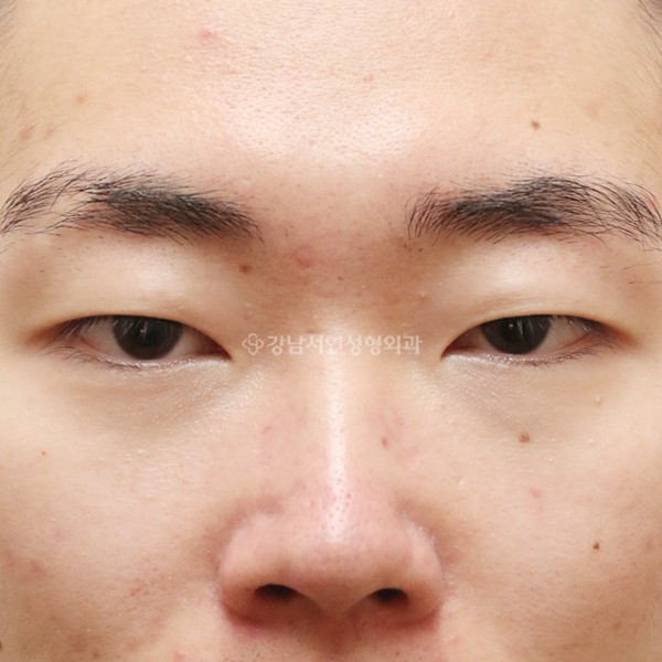 절개눈매교정 BEFORE