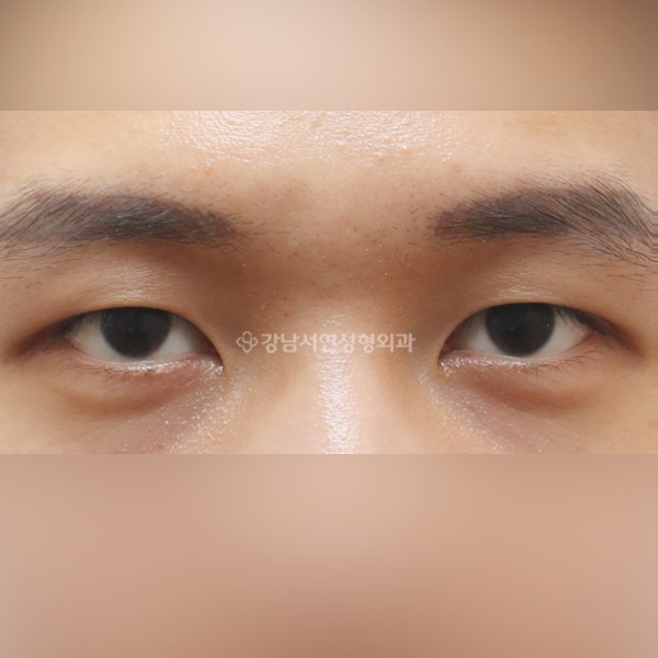 절개눈매교정 AFTER