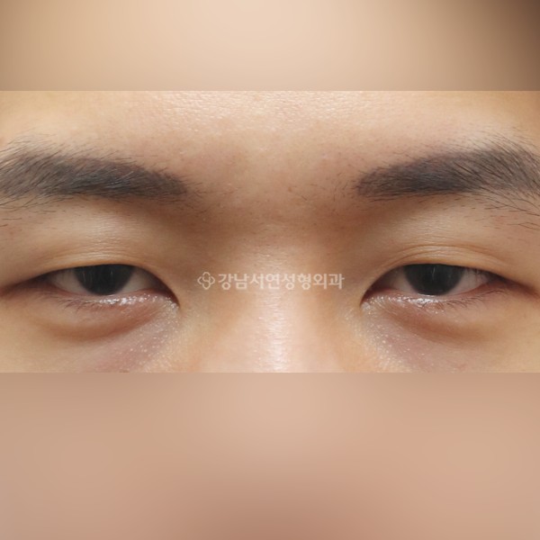 절개눈매교정 BEFORE