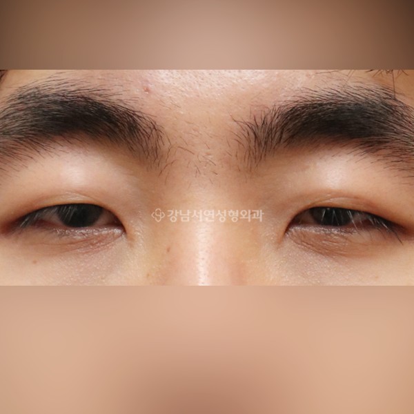 절개눈매교정+앞트임 BEFORE