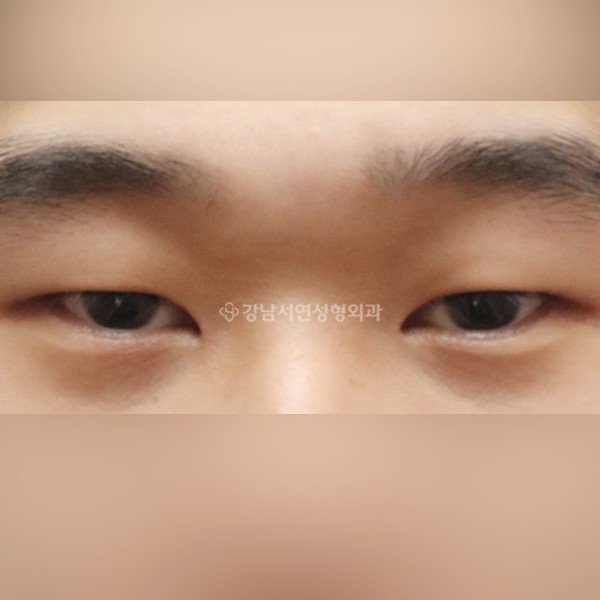 절개눈매교정 BEFORE