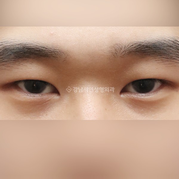 절개눈매교정 AFTER