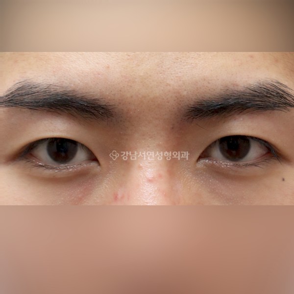 절개눈매교정 AFTER