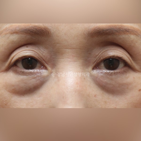 상안검 + 하안검 BEFORE