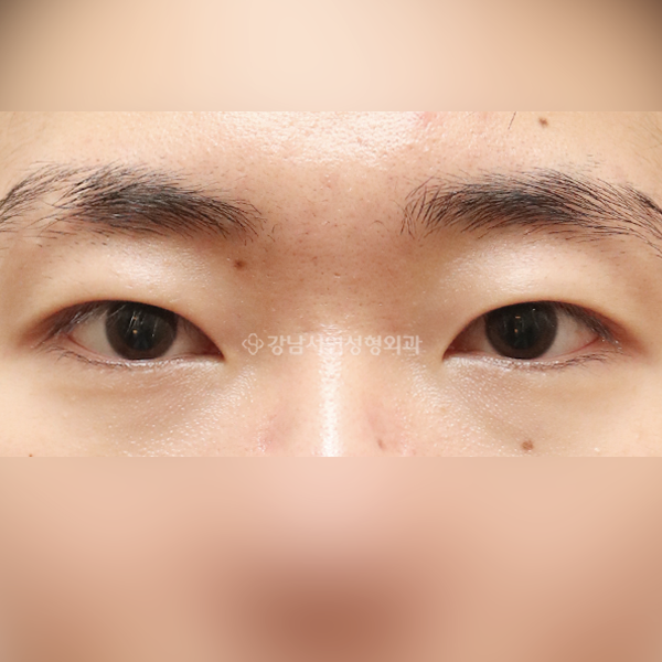 절개눈매교정 AFTER