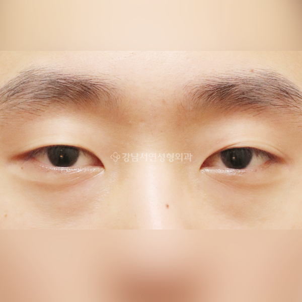 절개눈매교정+앞트임 BEFORE