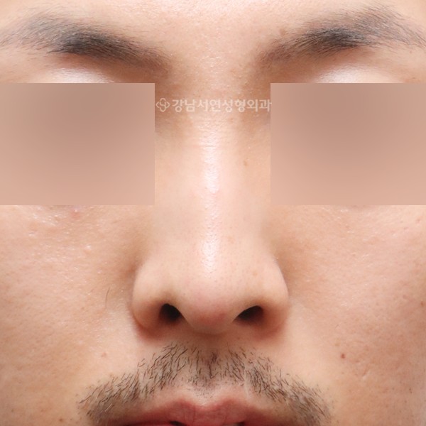 무보형물 코성형 정면 BEFORE