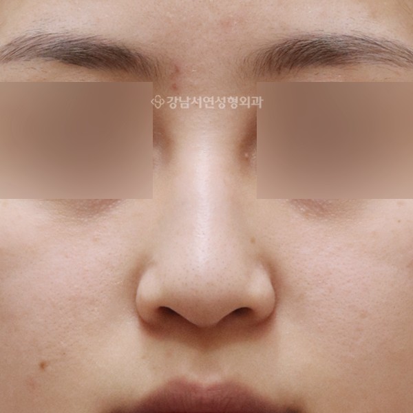 무보형물 매부리코성형 정면 BEFORE