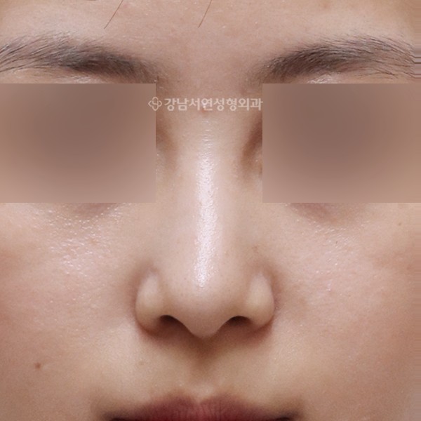 무보형물 매부리코성형 정면 AFTER