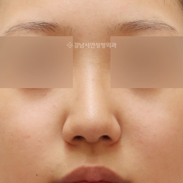 무보형물 코성형 정면 BEFORE