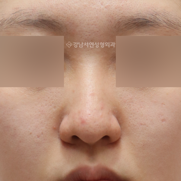 여자코성형 BEFORE