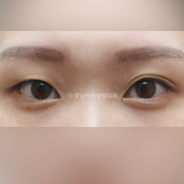 자연유착 쌍꺼풀 BEFORE
