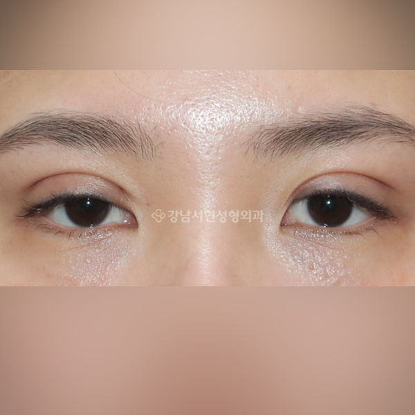 매몰실풀기 BEFORE