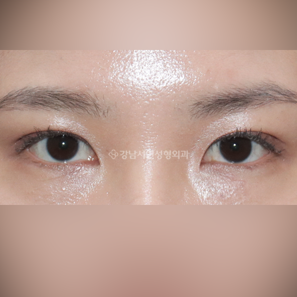 매몰실풀기 AFTER