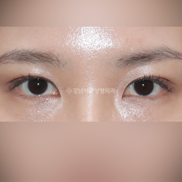 매몰실풀기 AFTER