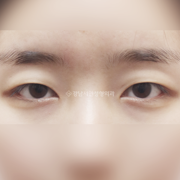 절개눈매교정 BEFORE