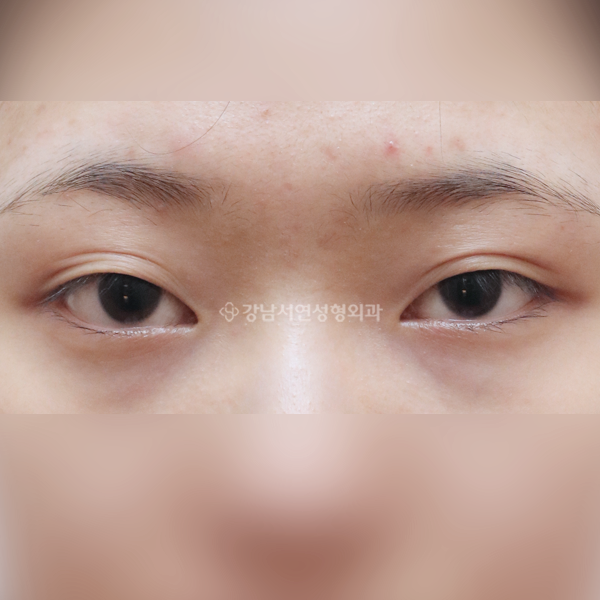 절개눈매교정 BEFORE