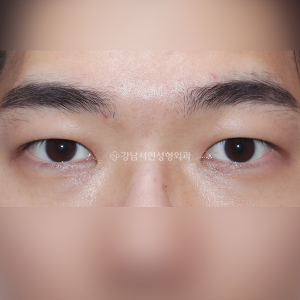 절개눈매교정 AFTER