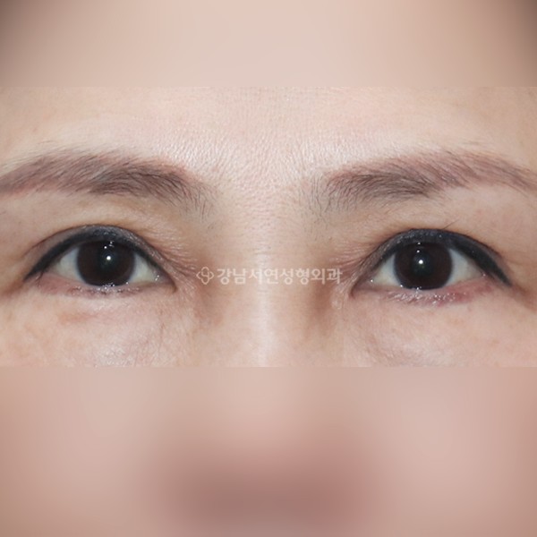 상안검 재수술 AFTER