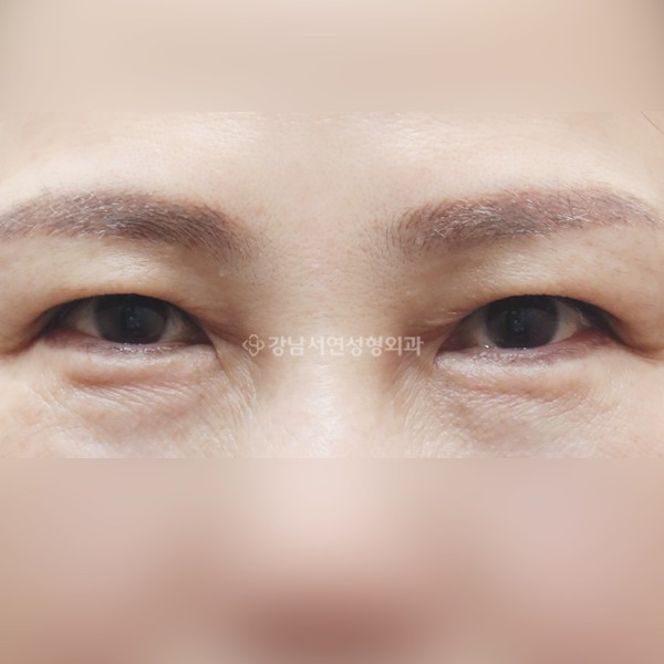 상안검 재수술 BEFORE