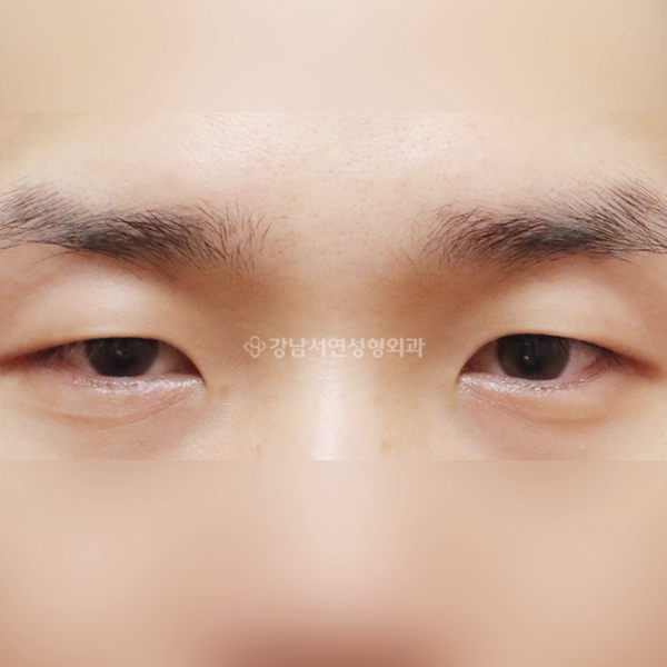 절개눈매교정 앞트임 BEFORE