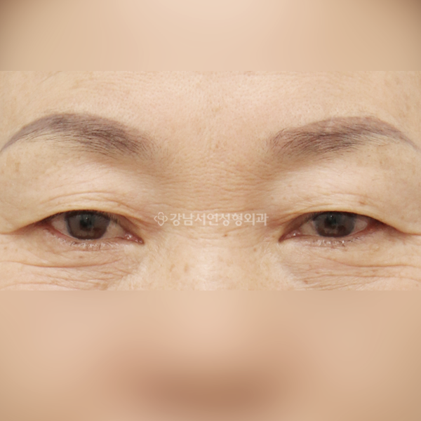 상안검 BEFORE