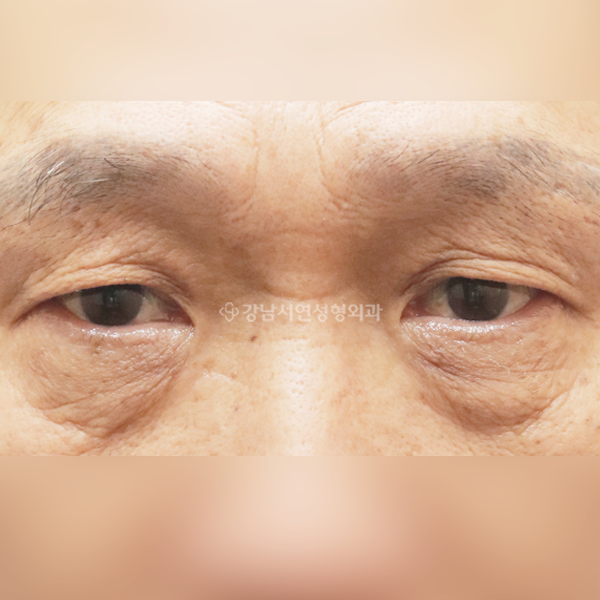 상안검+하안검 BEFORE