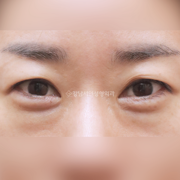 눈밑지방재배치 BEFORE