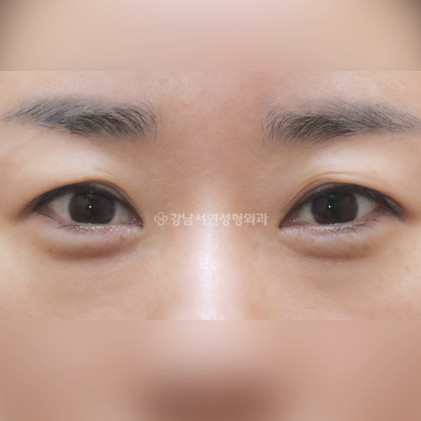 눈밑지방재배치 AFTER