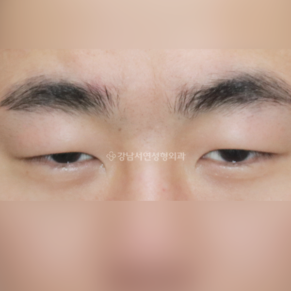 절개눈매교정+앞트임 BEFORE