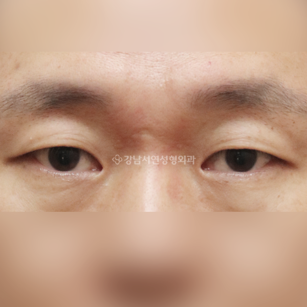 절개눈매교정+앞트임 BEFORE