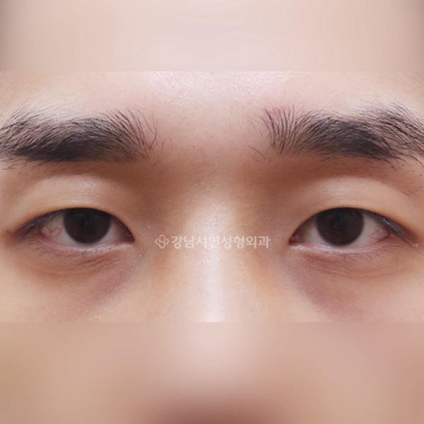 절개눈매교정 AFTER