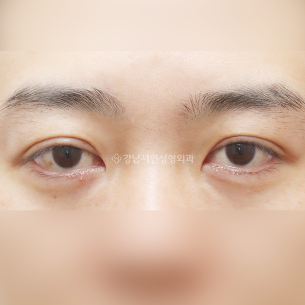 절개눈매교정 BEFORE