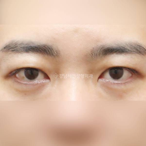 절개눈매교정 AFTER