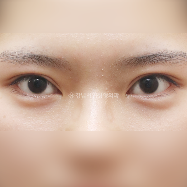 쌍꺼풀 재수술 AFTER
