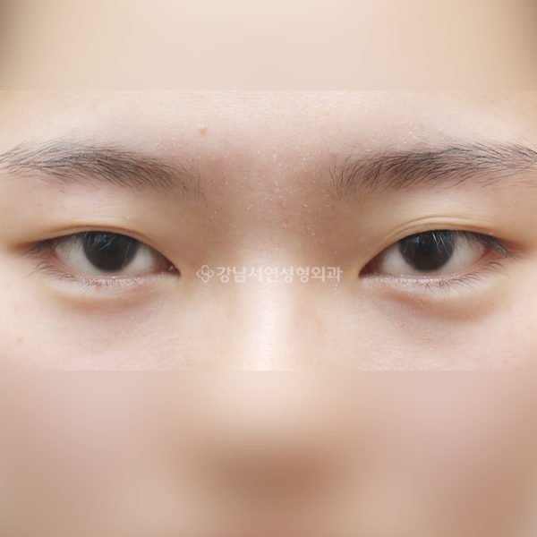 쌍꺼풀 재수술 BEFORE