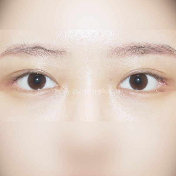 쌍꺼풀 재수술 AFTER