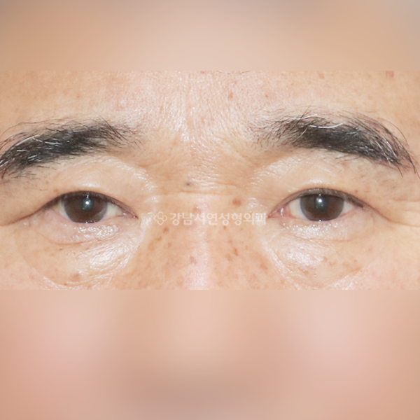 상안검 AFTER
