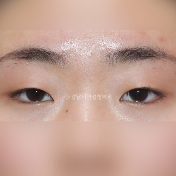 절개눈매교정+앞트임+뒷트임+밑트임 BEFORE